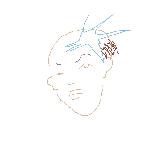 Glatze