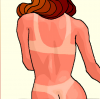 sunburn (expert)